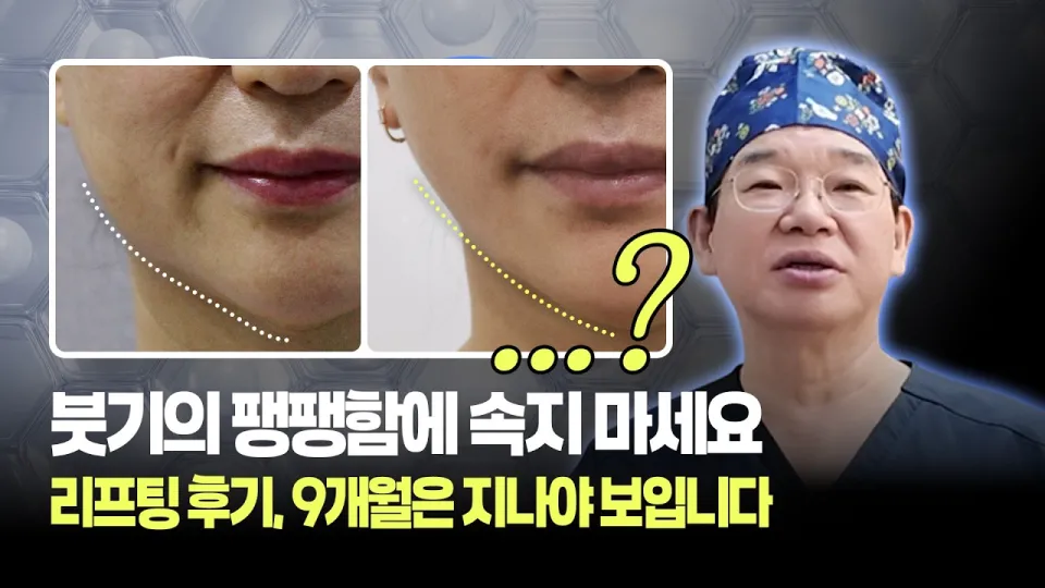 리프팅시술은 붓기 아닌 9개월 후 진짜 라인을 완성해 얼굴 처짐 근본 개선을 가능하게 한다