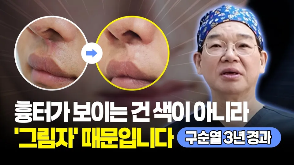 구순구개열 흉터, 다시 자르지 않고 지방줄기세포 이식으로 꺼진 인중 흉터 높이를 맞춥니다
